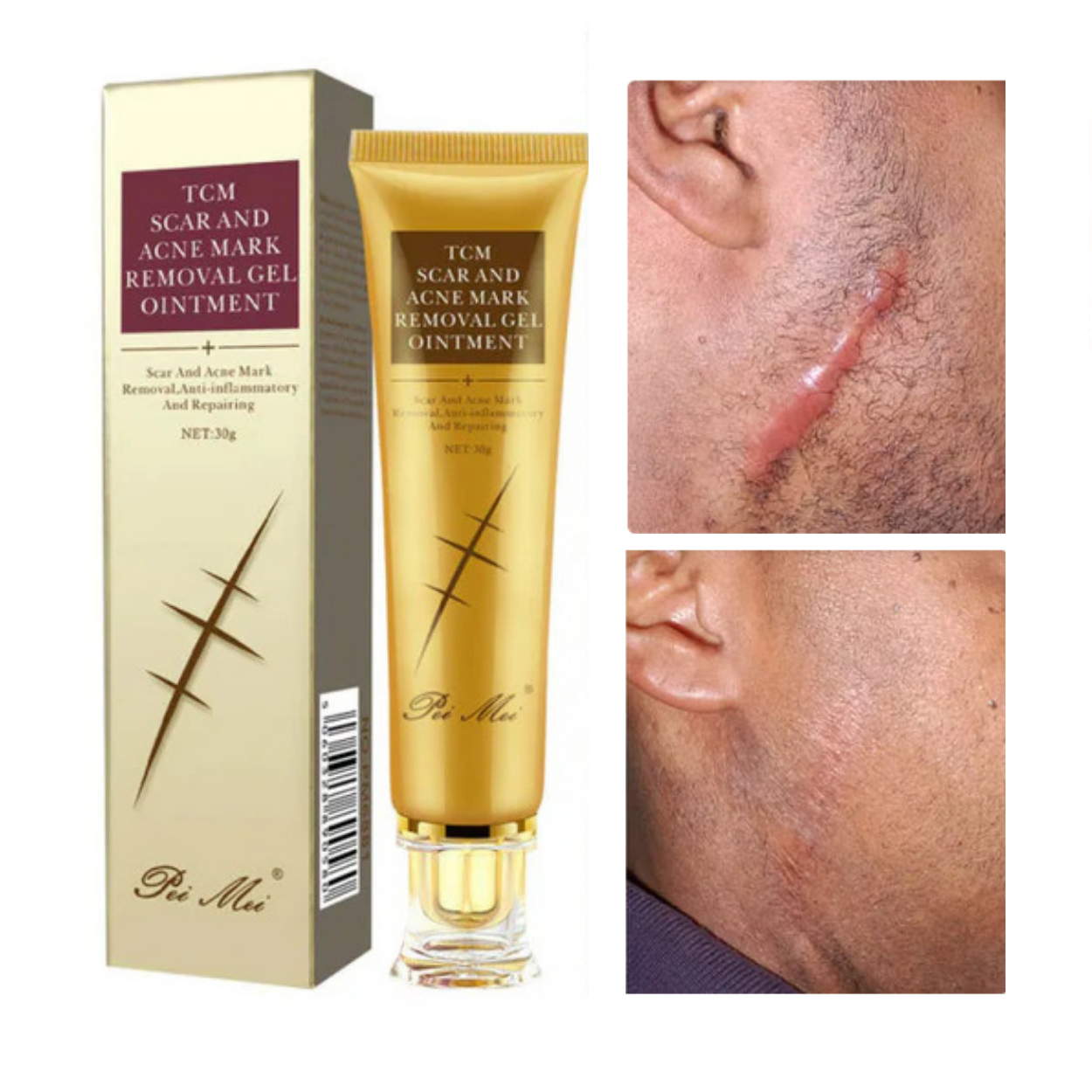 Gel Anti-Cicatrice et Vergeture LANBENA – Sentez-vous Bien dans Votre Peau