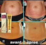 Gel Anti-Cicatrice et Vergeture LANBENA – Sentez-vous Bien dans Votre Peau