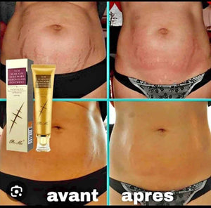 Gel Anti-Cicatrice et Vergeture LANBENA – Sentez-vous Bien dans Votre Peau